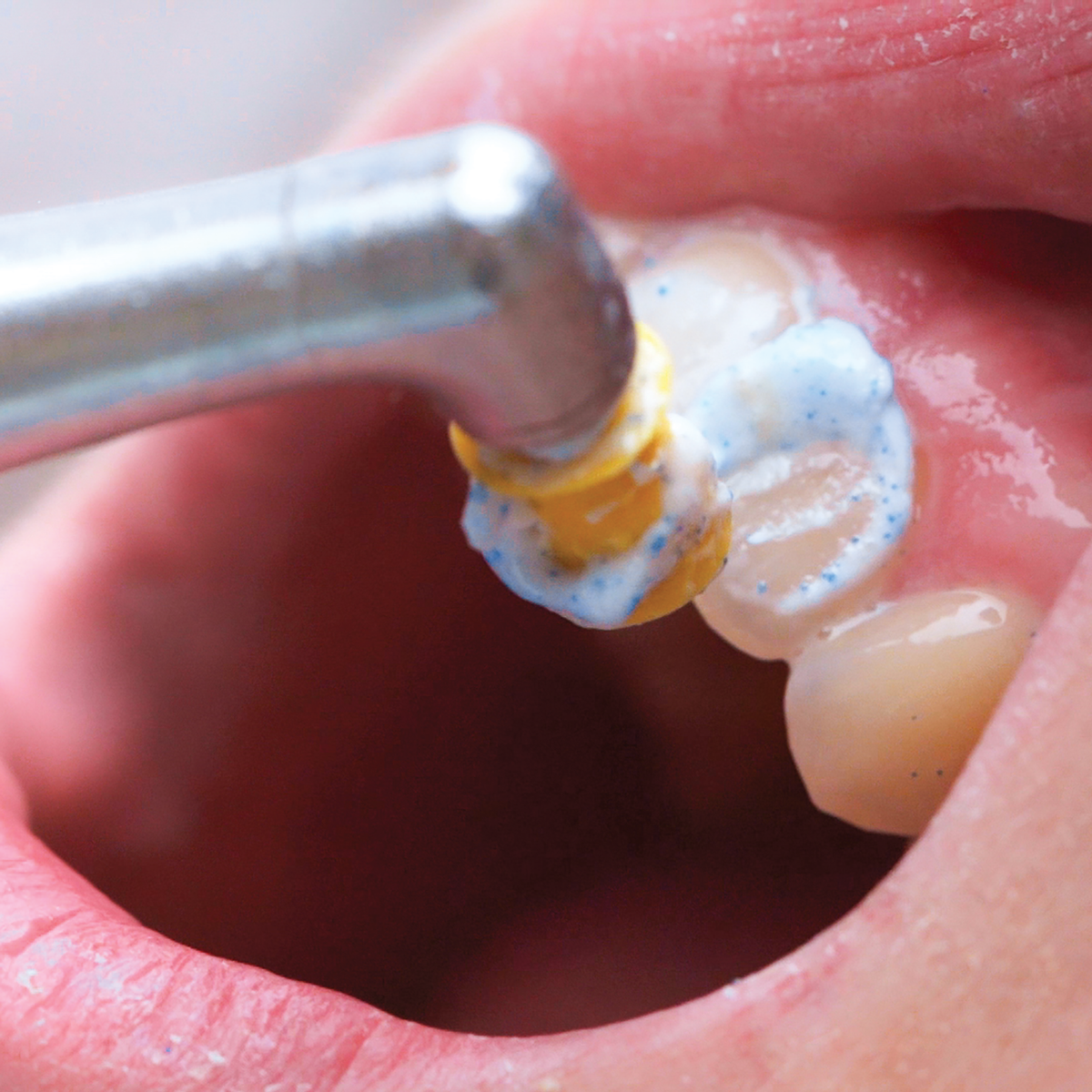 Application on a Patient