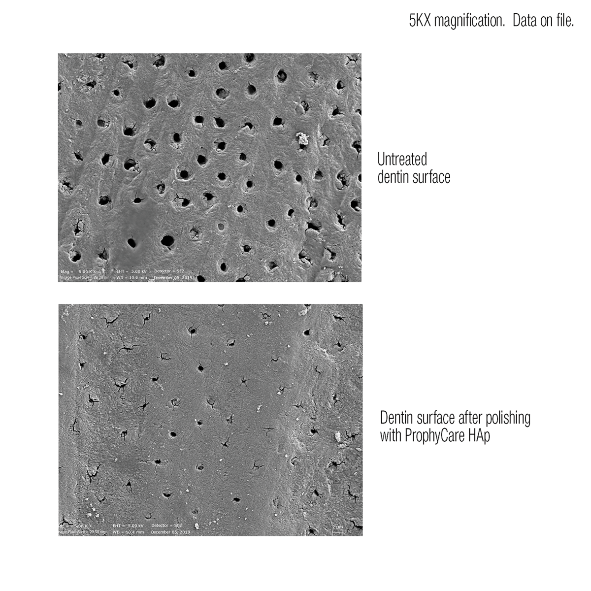 5KX Magnification of Dentin Surface