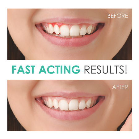 Before & After Results of the Perio Armor 1.7% HP Oral Cleansing Gel