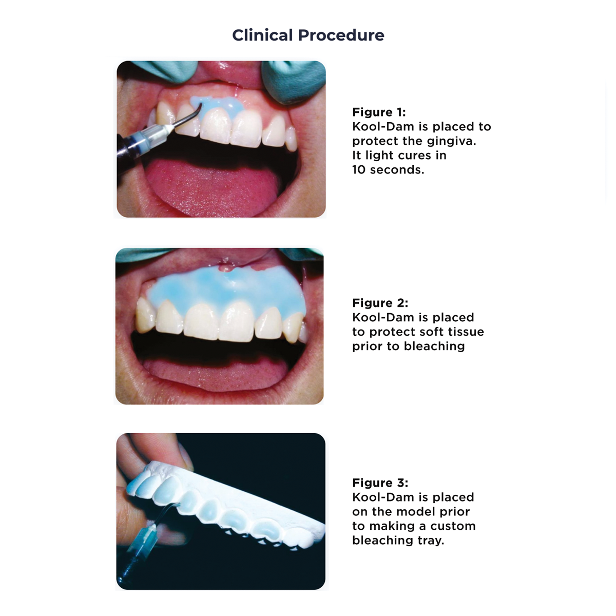 Pulpdent Kool-Dam Clinical Procedure