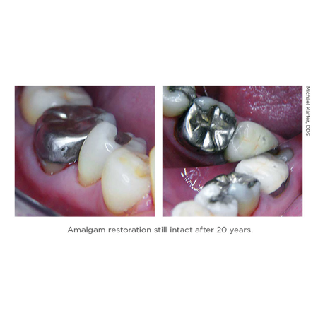 Amalgam Restoration