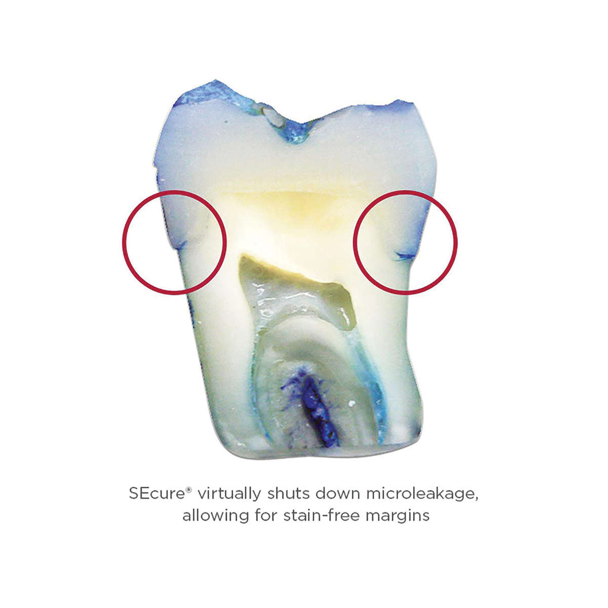 Tooth Using Parkell SEcure Resin Cement