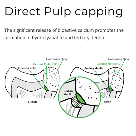 Direct Pulp Capping