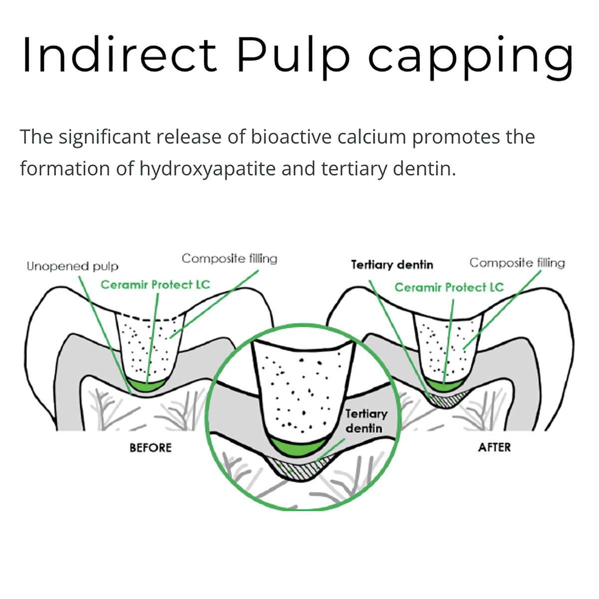 Indirect Pulp Capping