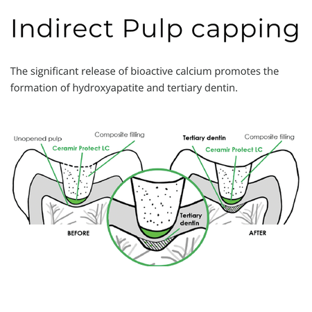 Indirect Pulp Capping