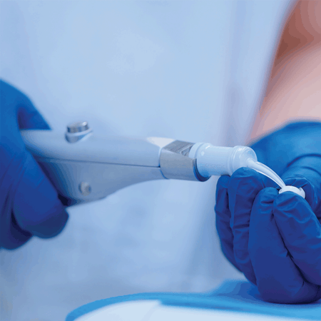 Using the Ceramir QuikCap Applicator 2 Instrument