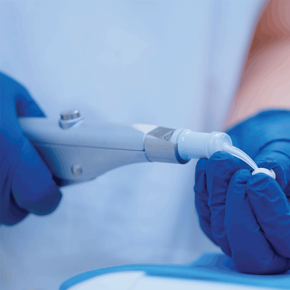 Using the Ceramir QuikCap Applicator 2 Instrument
