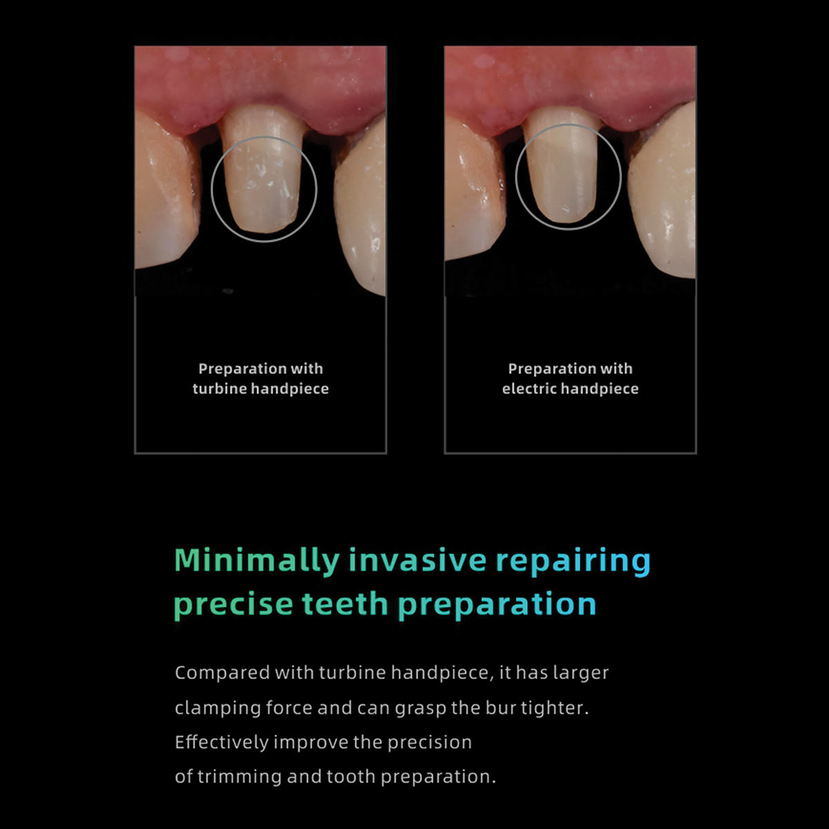 Tooth Prep Comparison Between Turbine Handpiece and Electric Handpiece