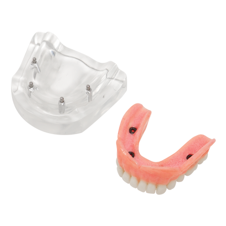 Lower Overdentures Model (4 Implants)