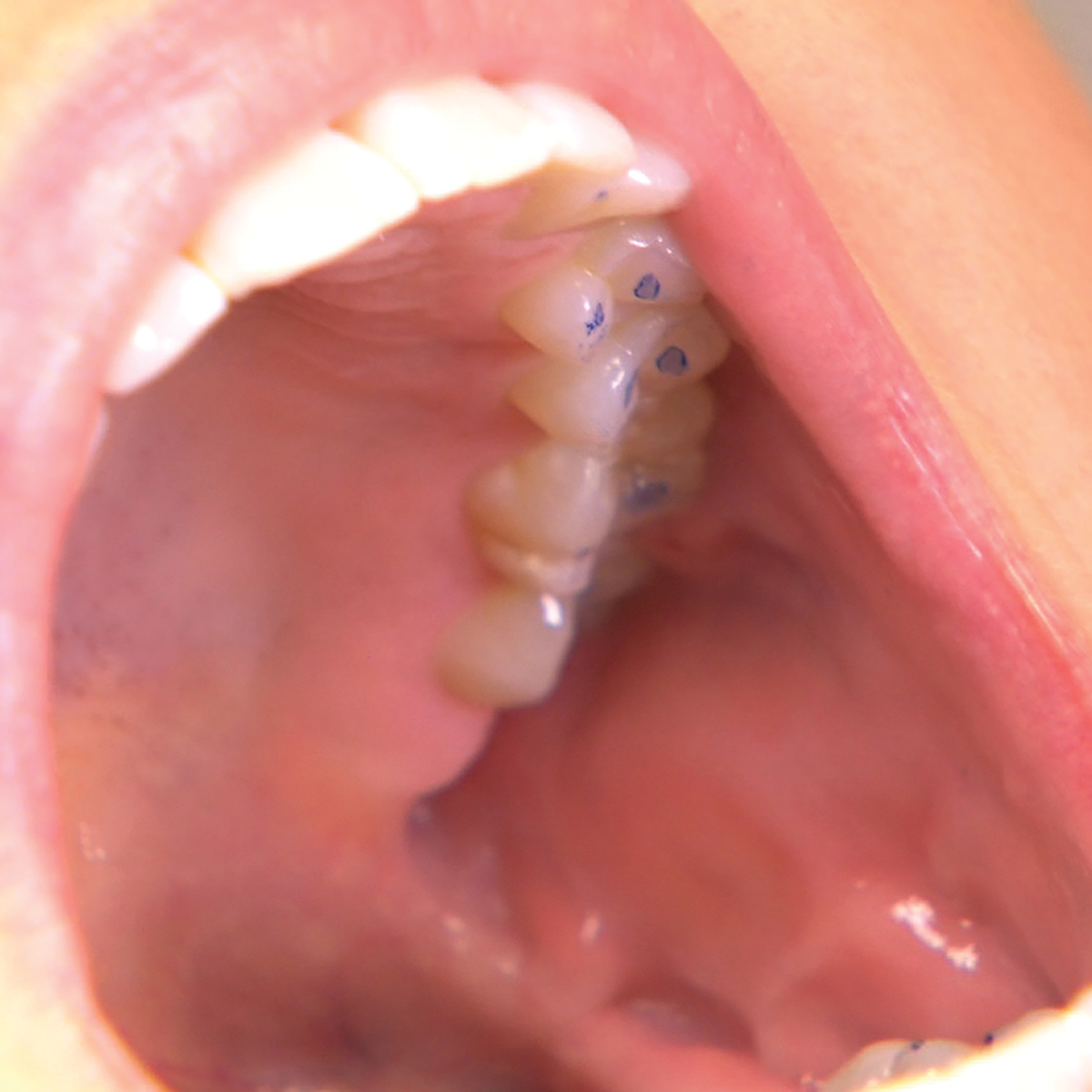 Markings Inside the Mouth