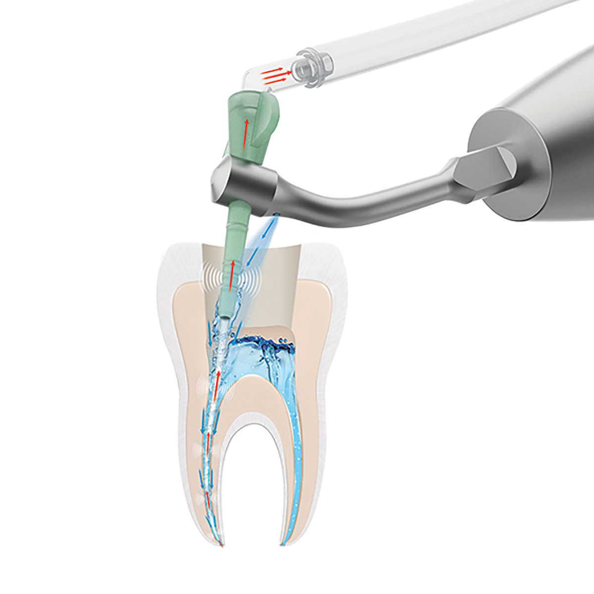 Endodontic Irrigation of Root Canal