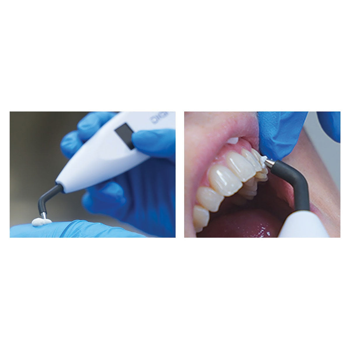 Testing Pulp on a Dental Patient