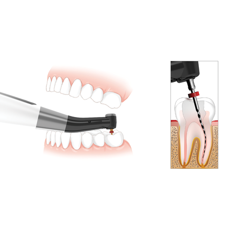 Canal Reach With Handpiece