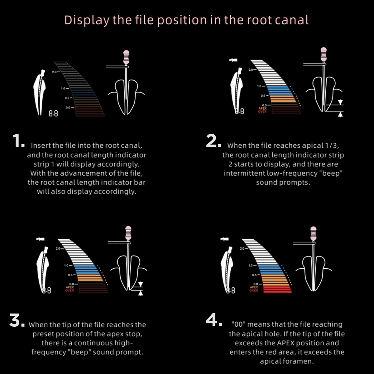 File Positioning of DPEX V Apex Locator