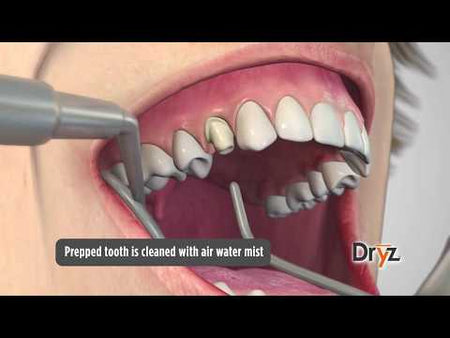 Parkell Dryz Hemostatic Retraction Paste Video