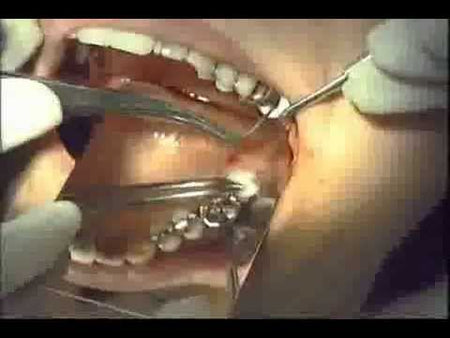 Foundation Bone Augmentation Video