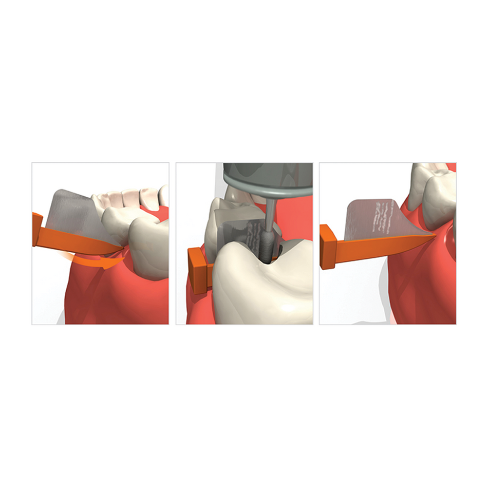 Demonstrating Inserting the Wedge