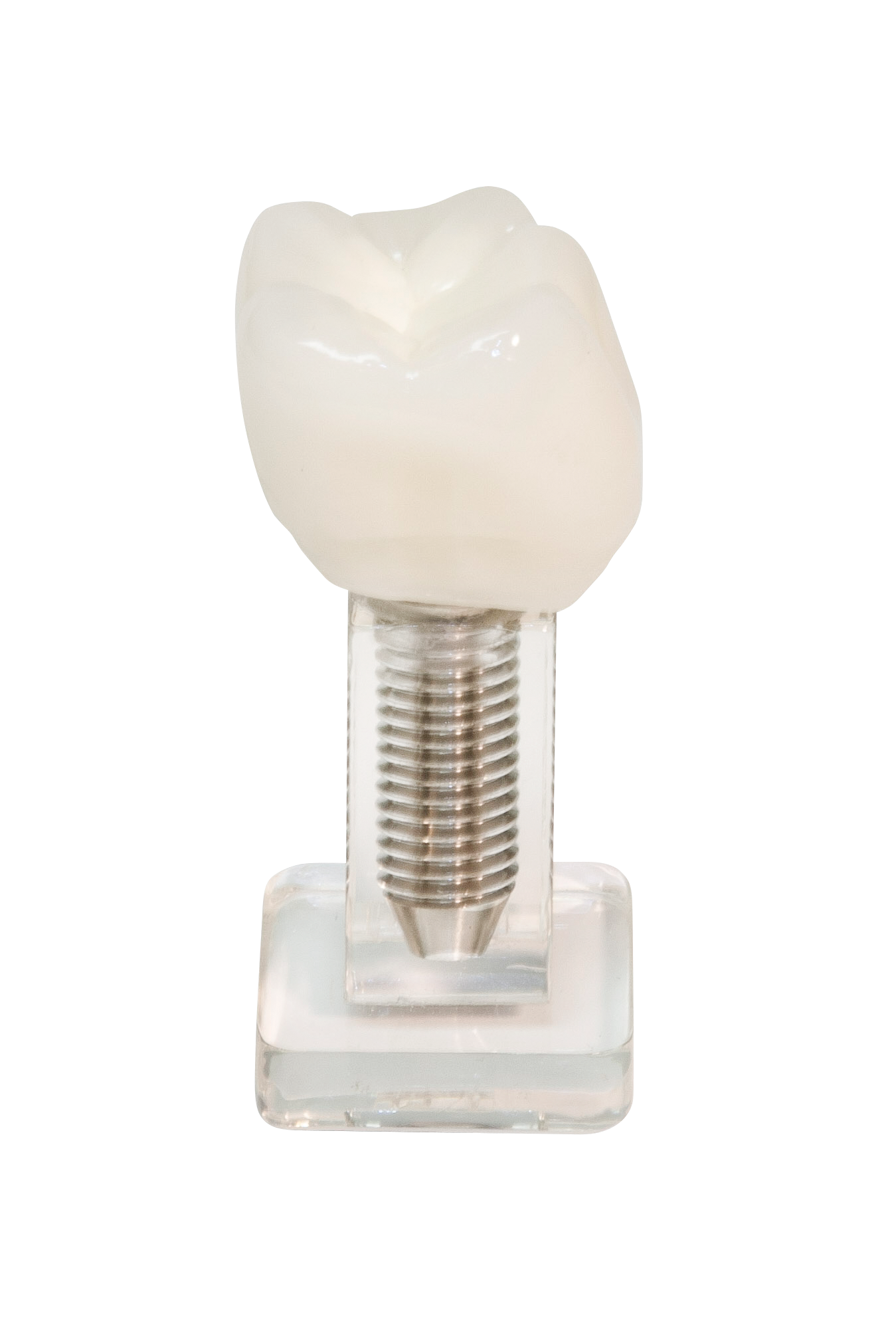 Single Tooth Implant Model