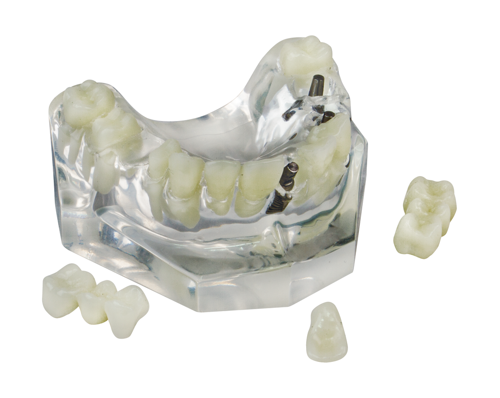 Kilgore Implant Bridge vs Standard Bridge Mouth Model