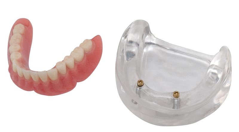 Locator Zest Denture Model - 2 Implants