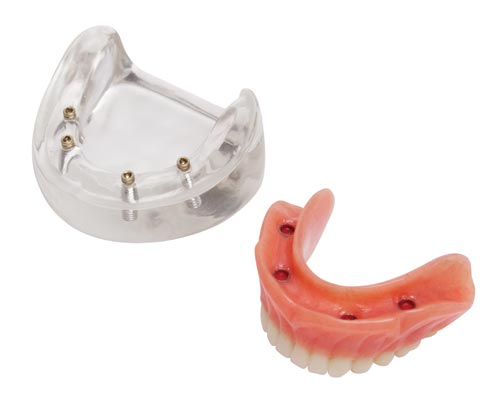 Locator Zest Denture Model - 4 Implants