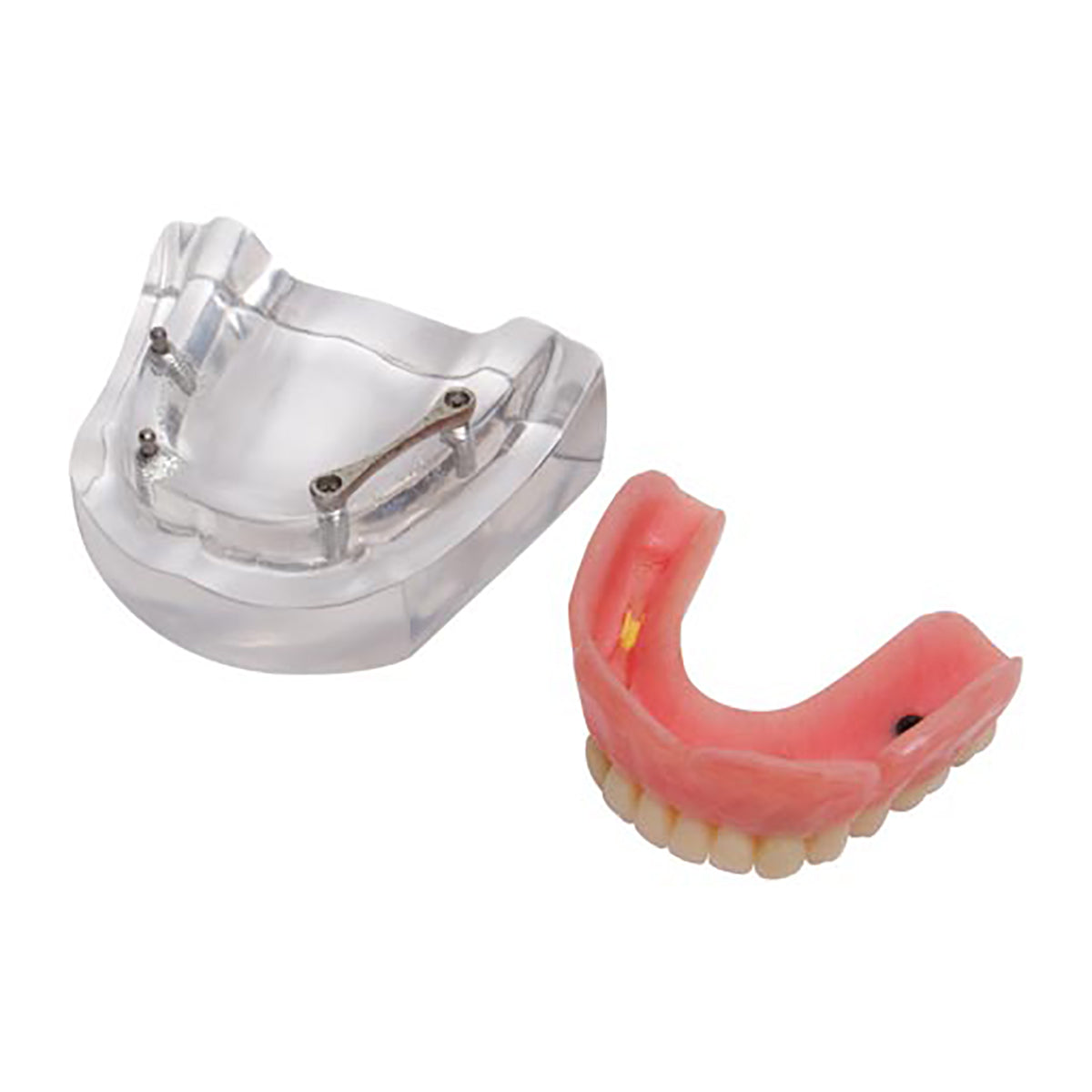 Implant Model - Ball Anchor & Hader Bar