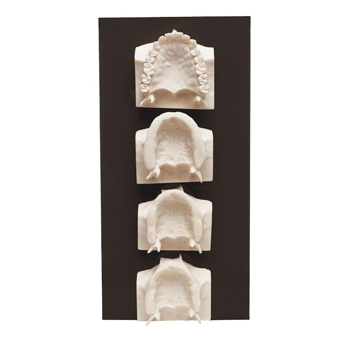 Maxilla Bone Loss Model