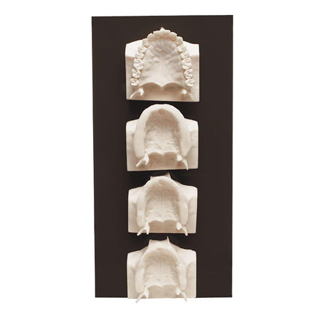 Maxilla Bone Loss Model