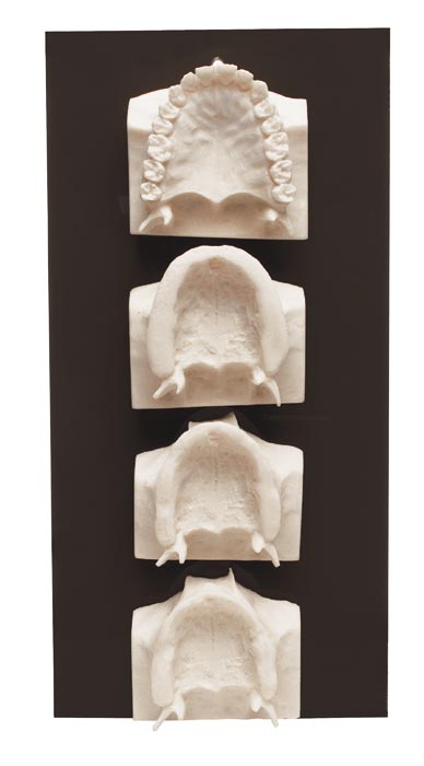 Maxilla Bone Loss Model