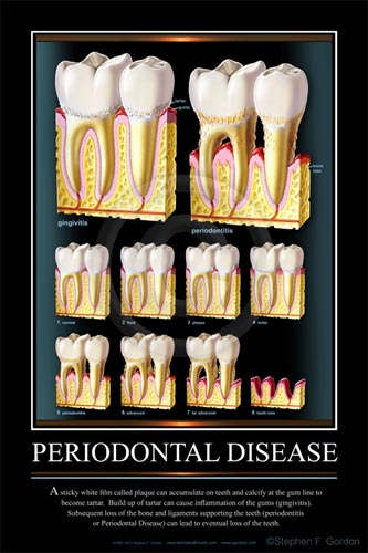 Periodontal Disease Poster - American Dental Accessories, Inc.