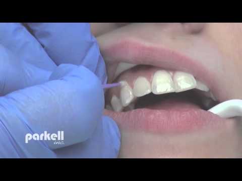 Desensitizing tooth surfaces using Brush&Bond or Pain-Free F.
