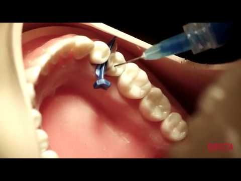 Video on Education Clinical Tips FenderMate® by Directa